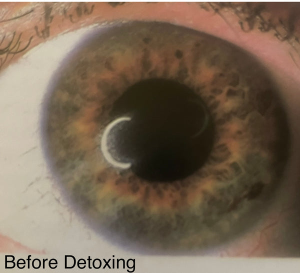 Iridology Consultation+Personalized Detox Plan